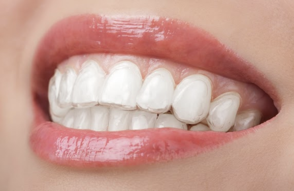 Benefits Of A Better Smile I Adult Braces Barrington I Jaffe Orthodontics
