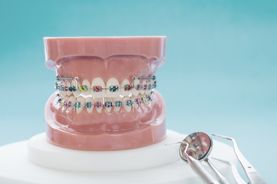 Traditional Metal Braces Jaffe Orthodontics